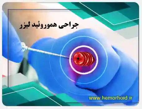 درمان هموروئید یا بواسیر با لیزر در لشکرک
